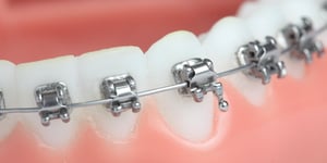 Understanding buccal tube failures: a guide for orthodontic success